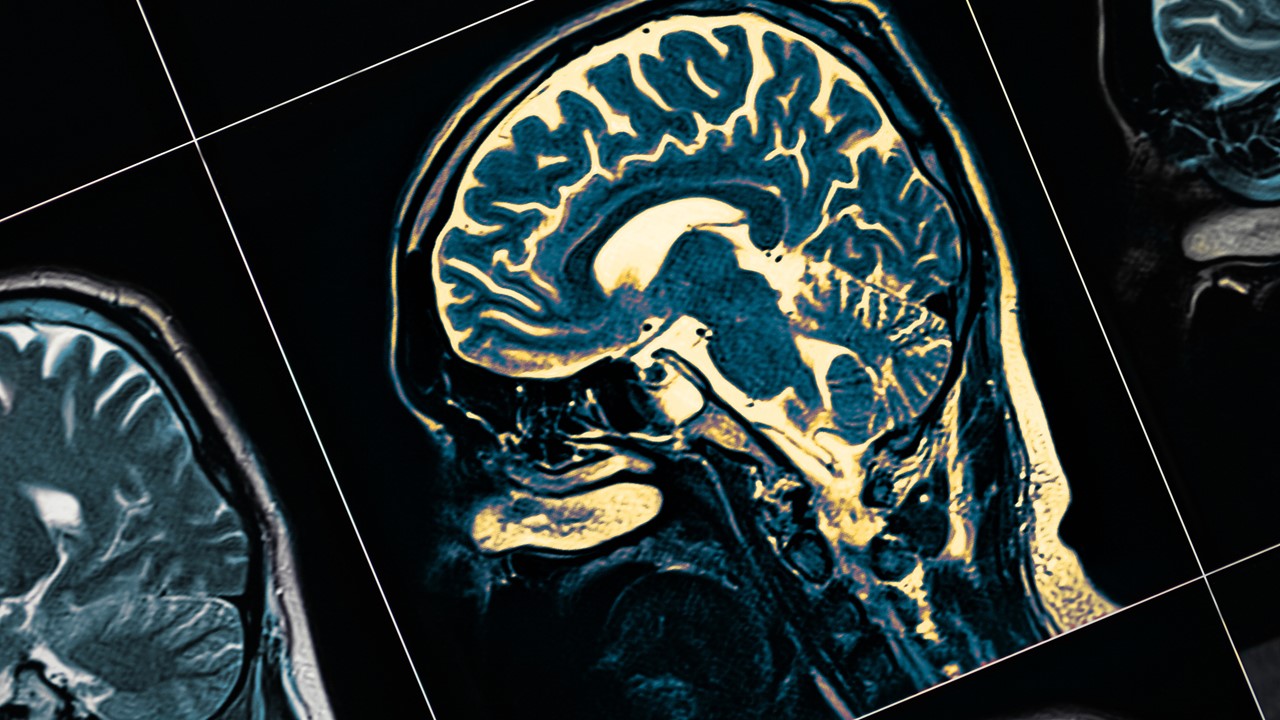 MRI of a patient's brain